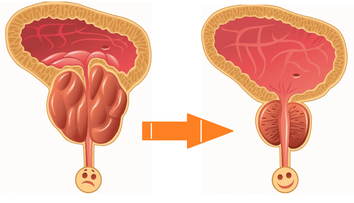 Uromexil Forte-en eragina prostatitisarekin eta adenomarekin prostatan